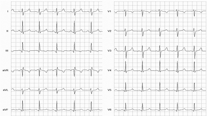 Normal Sinus Rhythm 12 Lead EKG